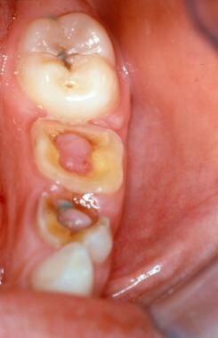 Pulp polyps involving the primary, first, and seco