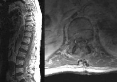 This MRI demonstrates spinal epidural hematoma. 