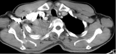 A 74-year-old male with Pancoast tumor. An axial C