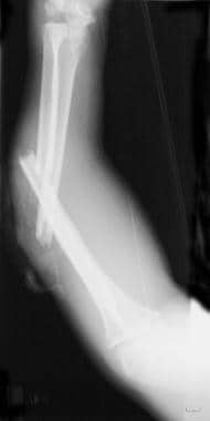 Lateral radiograph of open middle-third fracture o