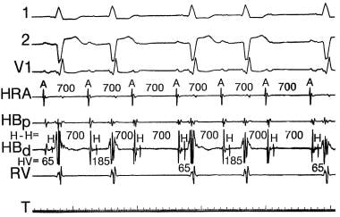 Second-Degree Atrioventricular Block. Sinus rhythm