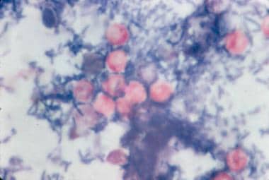 Modified acid-fast stain of stool shows red oocyst