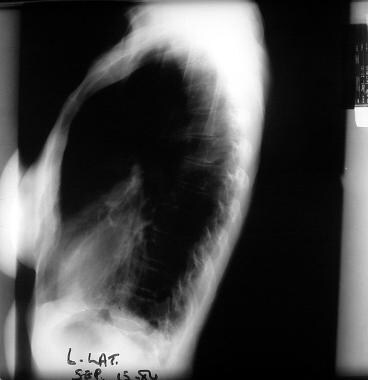 Emphysema. An emphysematous lung shows an increase
