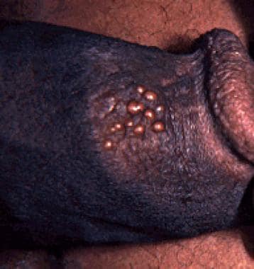 Penile infection with herpes simplex virus type 2.