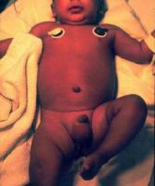 Emergency room photograph of an infant with septic