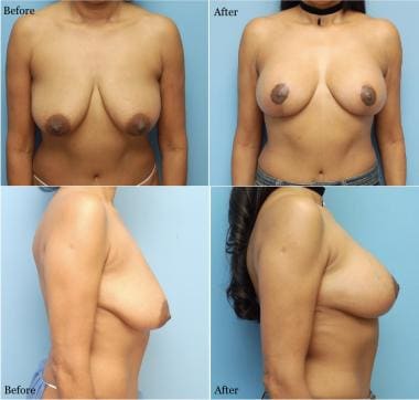 A breast lift and a breast augmentation were perfo