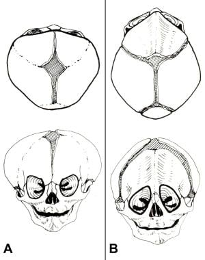 Congenital, synostoses. (A) In brachycephaly, both