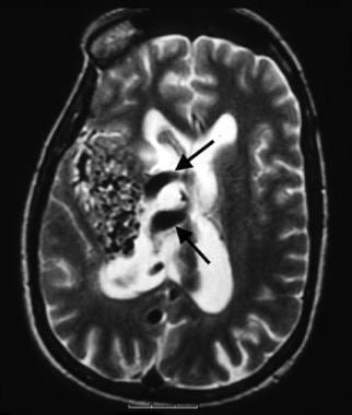 A 44-year-old woman presented with left-sided hemi