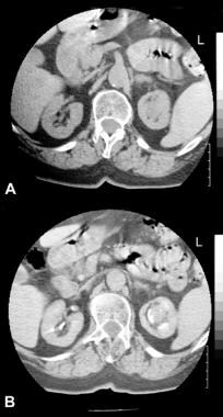 Nonenhanced (top) and enhanced (bottom) CT scans o