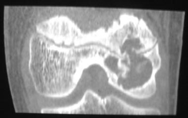 Coronal reconstructed computed tomography scan of 