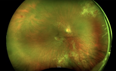 Wide-field fundus photograph showing multifocal in