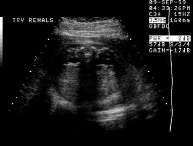 A second prenatal sonogram, transverse view (same 