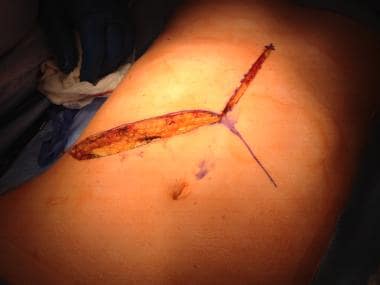 Incision for living donor hepatectomy. The left la