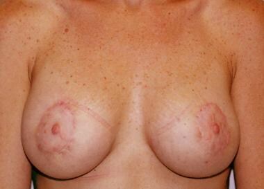 Breast mastopexy. Postoperative anterior view 3 mo