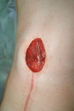 Repair of defect secondary to spina bifida at the