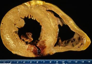 Acute myocardial infarction, reperfusion type. In 