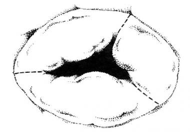 Tricuspid Stenosis. A representation of a stenotic