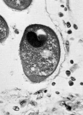 Trophozoite of Balantidium coli in colon. This pho