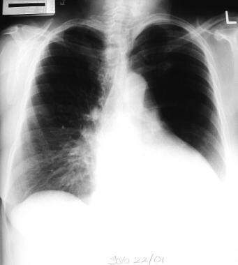 Emphysema. The differential diagnosis of a unilate