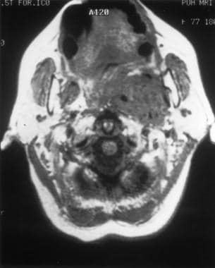 MRI of a poststyloid mass. Note anterior displacem