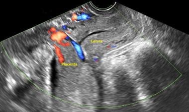 Complete placenta previa noted on ultrasound. 