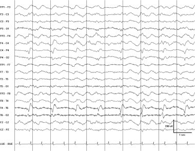 Pseudoperiodic lateralized epileptiform discharges