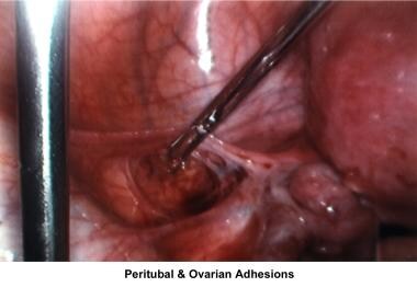 Infertility. Peritubal and ovarian adhesions. Imag