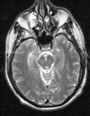 Axial magnetic resonance image in a 59-year-old pa