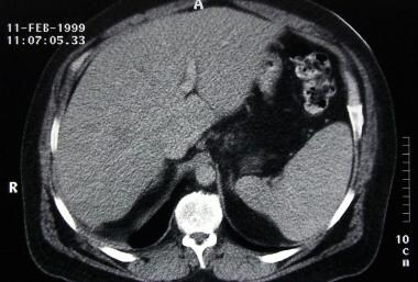 Constrictive pericarditis. The liver in this CT sc