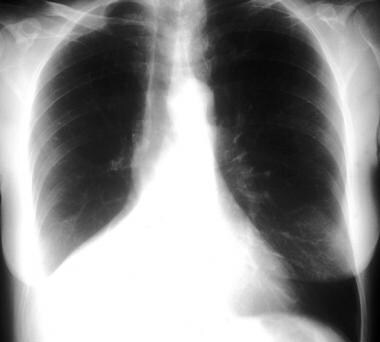 Chest radiograph demonstrating a right lower lobe 