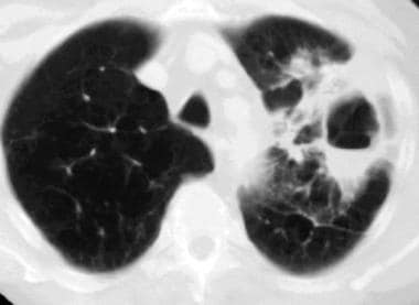 Computed tomography scan, pulmonary window setting