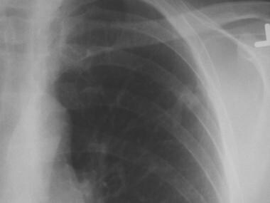 Chest radiograph of a left upper lobe solitary pul