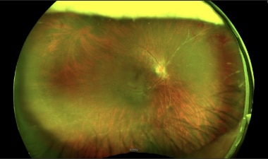 Wide-field fundus photograph illustrating numerous