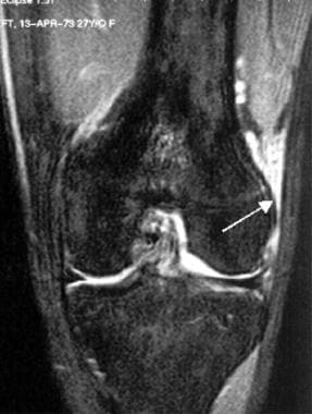 Extensor mechanism injuries of the knee. In this 2