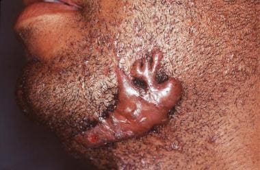 Clawlike outline of a keloid. Courtesy of Dirk M. 