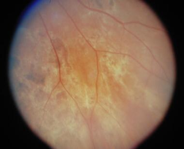 Inferior nasal of right eye of the same patient ap