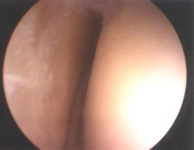 Grade III scapholunate tear, as depicted from the