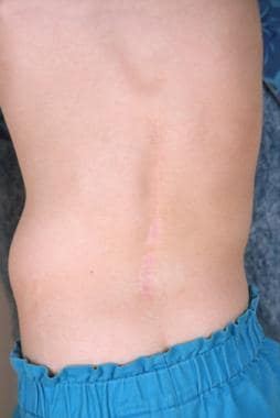 Complete healing of defect secondary to spina bifi