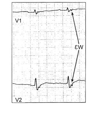 This image shows an epsilon wave on the electrocar