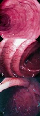 Tropical Sprue. Endoscopic views of unsuspected ce