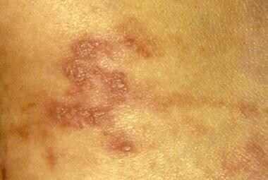 Phytophotodermatitis. Close-up view of vesicular l