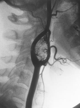 Angiogram of carotid body tumor. These are found b
