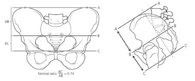 Calculation of the sacral ratio. 