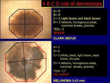 Application of ABCD rule of dermoscopy in melanocy