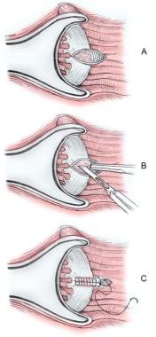 Lateral Anal Sphincterotomy 13