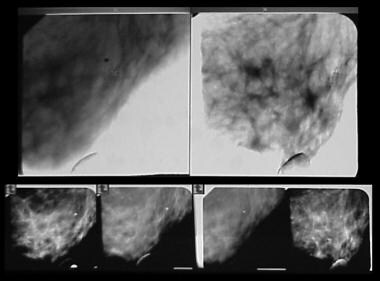 Stereotactic images obtained during a prone-table 