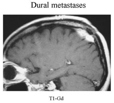 Sagittal contrast-enhanced MRI of a patient with k