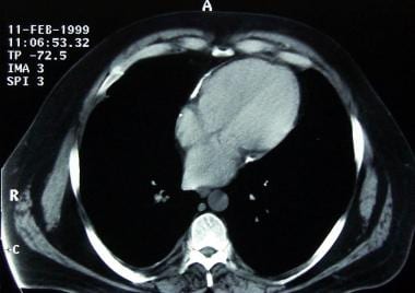 Constrictive pericarditis. The cardiac chambers in