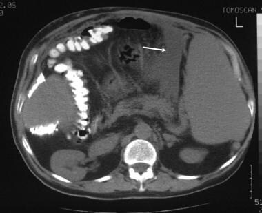 A 42-year-old man presented with an intractable as