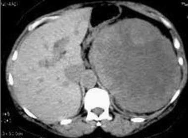 Case 7. Multifocal renal cell carcinoma in patient